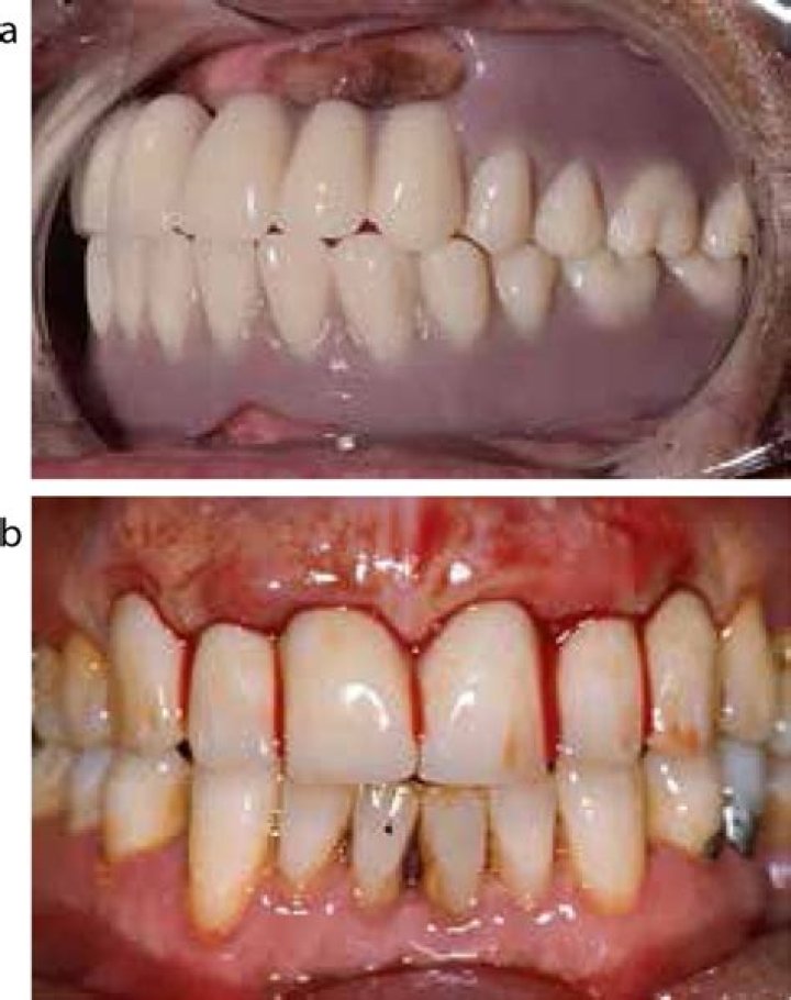 Day 3 After Immediate Dentures: Uncover Surprising Truths