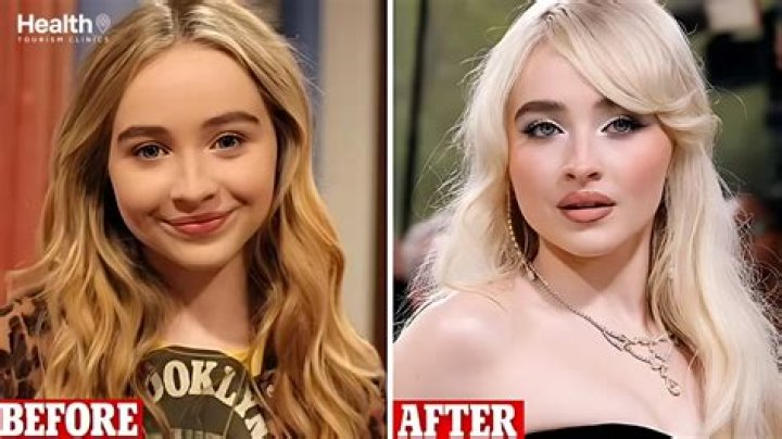 Unveiling The Truth: Did Sabrina Carpenter Get Lip Filler?