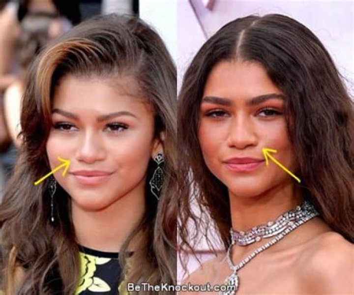 Zendaya's Plastic Surgery Journey Explored