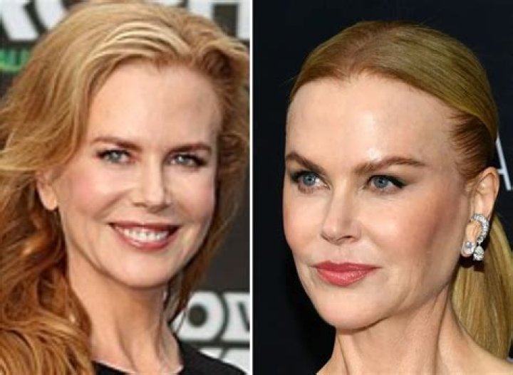 Does Nicole Kidman Have Implants: The Untold Truth