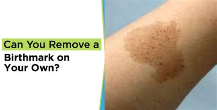 How Drew Brees Safely Removed His Birthmark | The Ultimate Guide