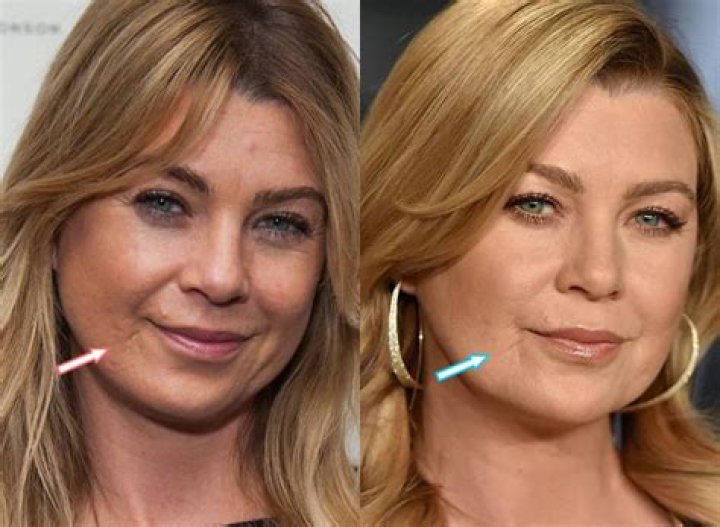 Exploring Ellen Pompeo's Lip Filler Journey
