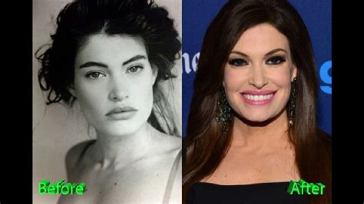 Kimberly Guilfoyle Enhances Her Beauty: A Plastic Surgery Journey