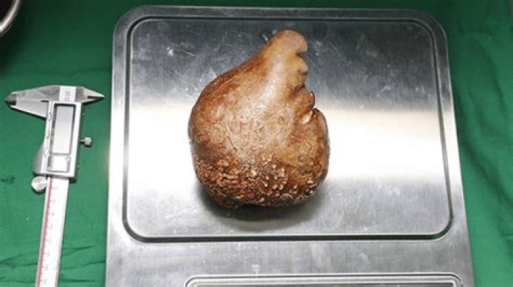 Largest kidney stones enters Guinness World Records |