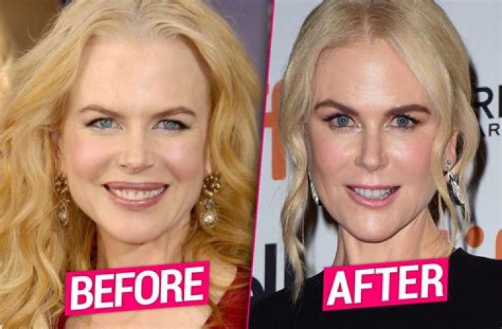 The Truth About Nicole Kidman's Use Of Botox: A Comprehensive Guide