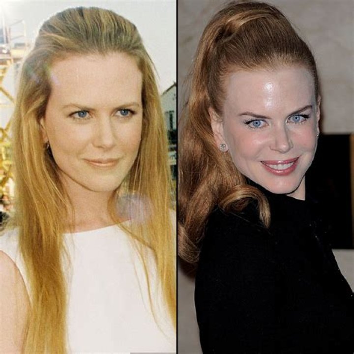 The Truth Behind Nicole Kidman's Alleged Face Surgery