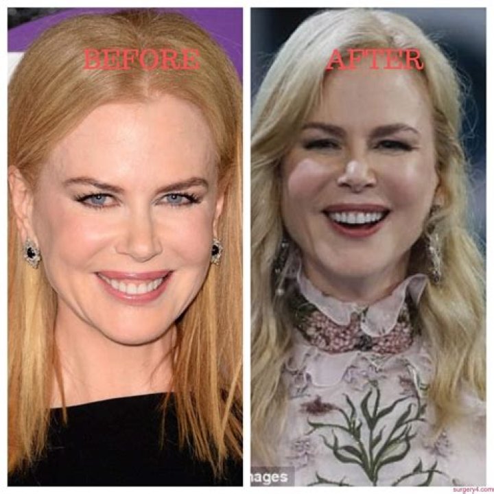 Nicole Kidman: The Truth Behind Her Plastic Surgery Journey