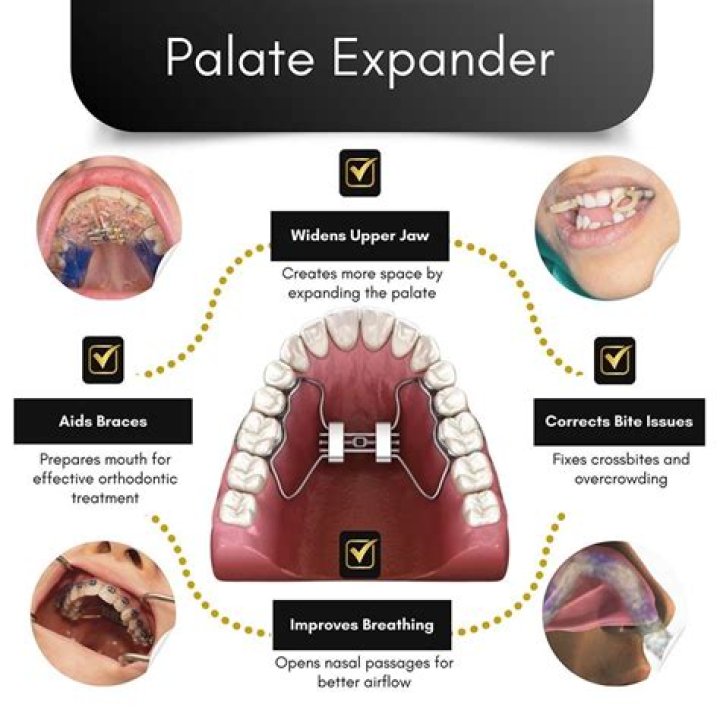 The Ultimate Palate Expander Guide: Find The Best On Amazon