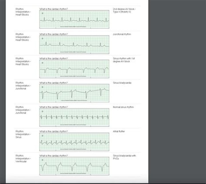 Unlock The Secrets Of Rhythm Interpretation With Relias Dysrhythmia Advanced Test Answers