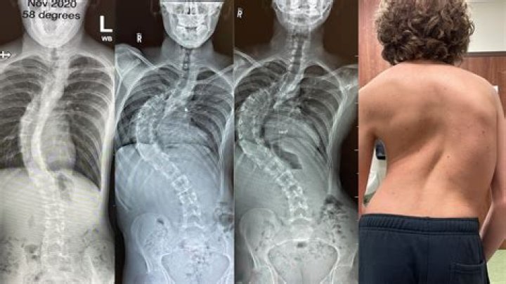 The Ultimate Guide To Scoliosis Scar Treatment And Prevention