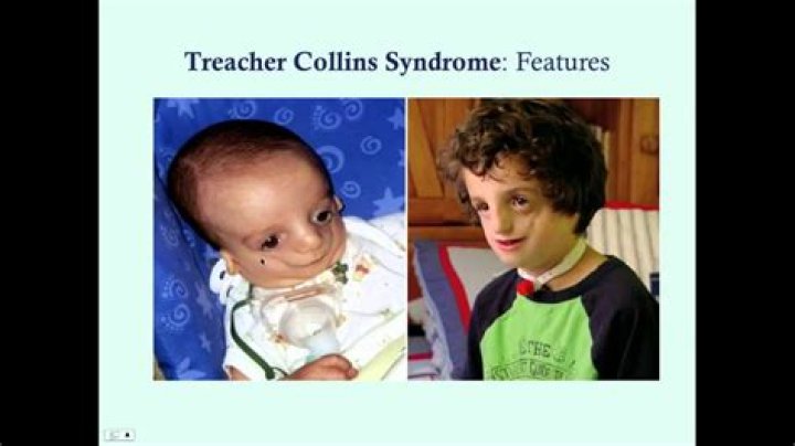 Inspiring Lives: Treacher Collins Syndrome Famous People