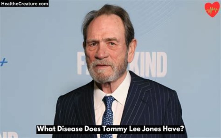 Unraveling The Mystery: What Disease Does Tommy Lee Jones Have?