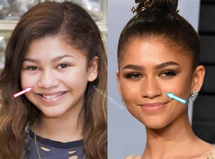 Zendaya Nose Job: Uncovering Truth And Insights